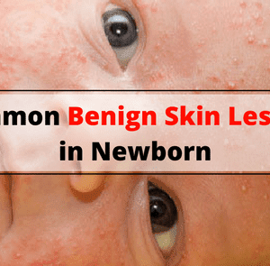 Common Benign Skin Lesions in Newborn Babies