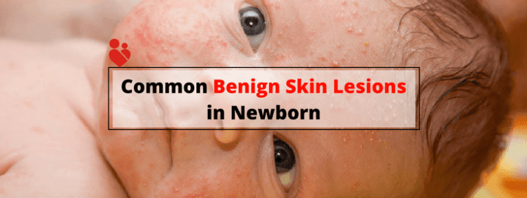 common-benign-skin-lesions-in-newborn-babies-motherhood-chaitanya