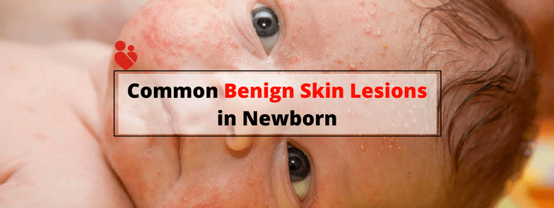 Common Benign Skin Lesions in Newborn Babies