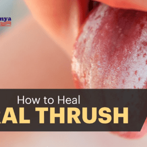 Causes and Treatment of Thrush in Infants
