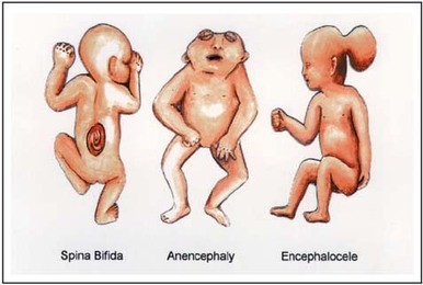 neural-birth-defects/birth-defects