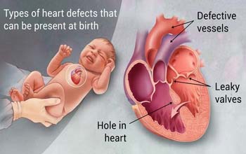 congenital-heart-defects/birth-defects