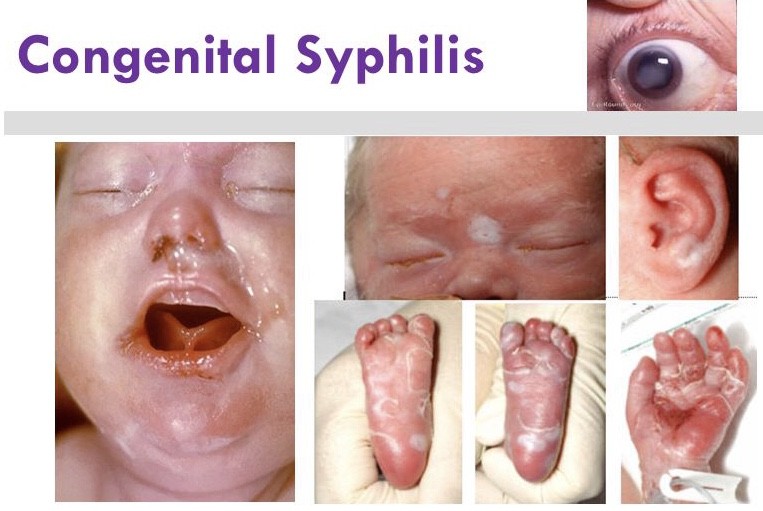 congenital-syphilis/birth-defects