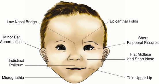 fetal-alcohol-syndrome/birth-defects