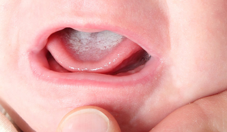 Oral Thrush (Mouth Thrush) In Kids: Treatment, Causes, Symptoms