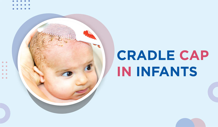 Cradle Cap in infants
